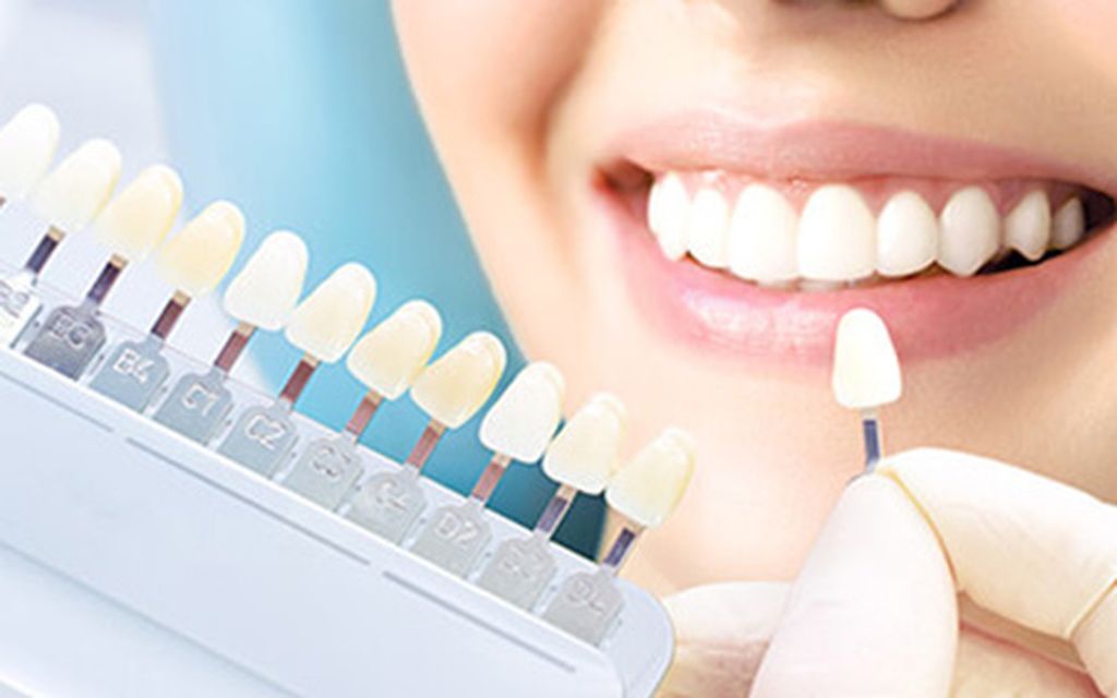 歯の美白（ホワイトニング）