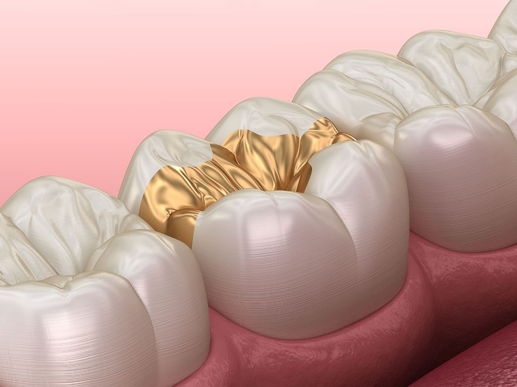 金の詰め物（ゴールドインレー）