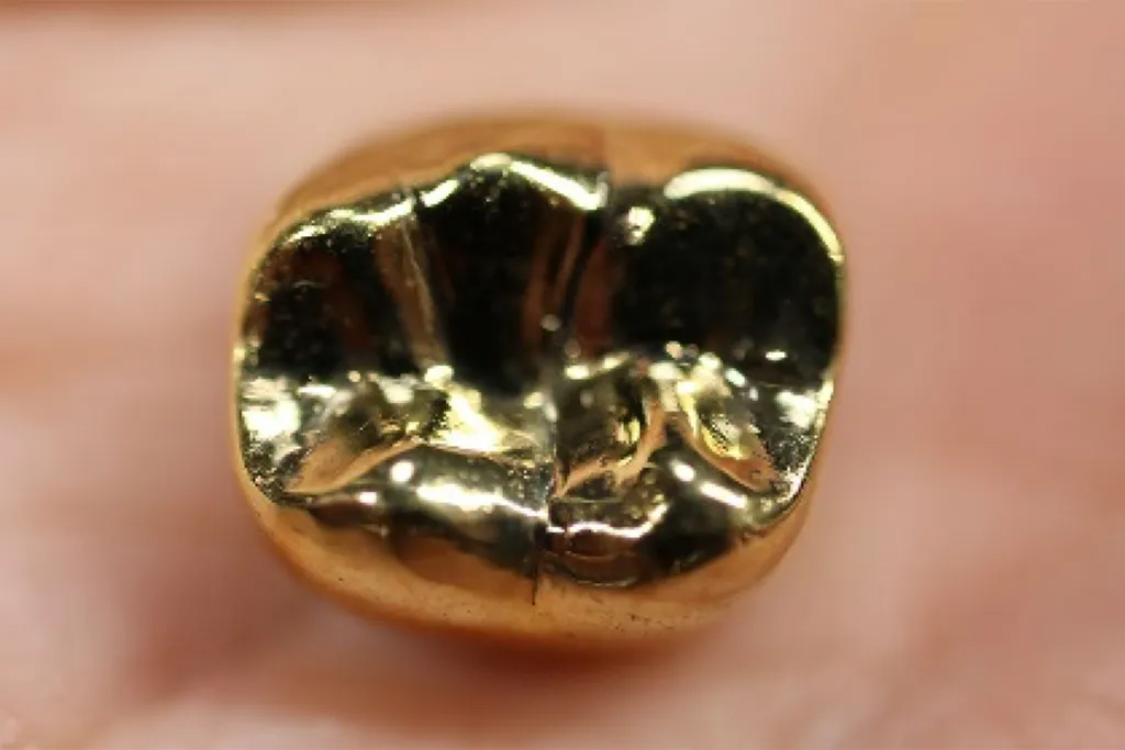 金の被せ物（ゴールドクラウン）